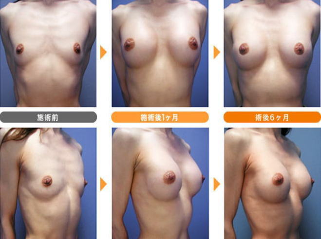 貧乳が巨乳に変身！豊胸手術のビフォーアフター比較画像