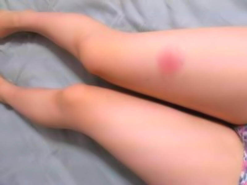 虫刺されの脚フェチ画像 ください 